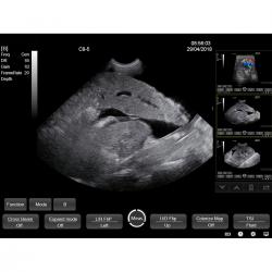 15-Дюймовый Сенсорный Цветной Допплер УЗИ